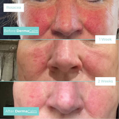 DermaCalm rescue mist spray